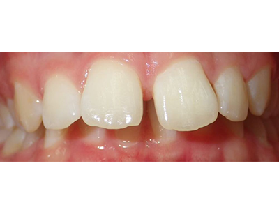 Before - Bright Oorthodontics