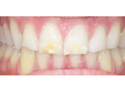 After - Bright Orthodontics