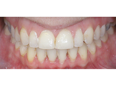 After - Bright Orthodontics